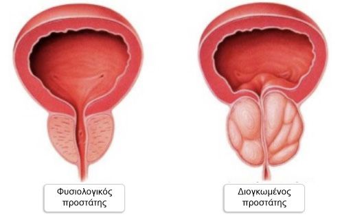 Kαλοήθης υπερπλασία προστάτη