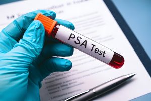 υπερπλασία προστάτη και PSA