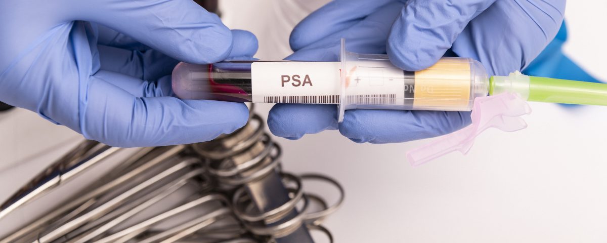 υψηλό PSA μετά από αφαίρεση προστάτη