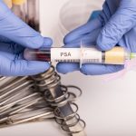 υψηλό PSA μετά από αφαίρεση προστάτη
