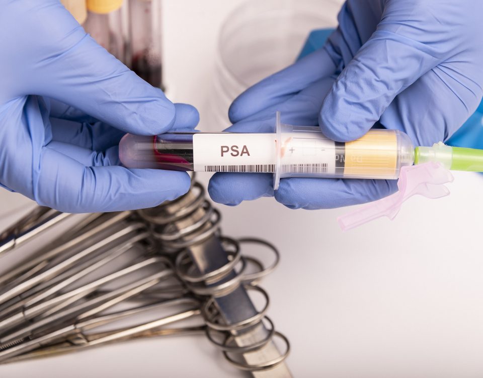 υψηλό PSA μετά από αφαίρεση προστάτη